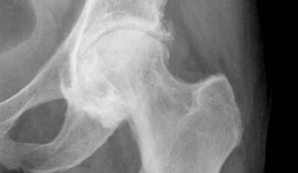 minimalinvasive-h-ftendoprothetik-htep-praxisklinik-z-hringen